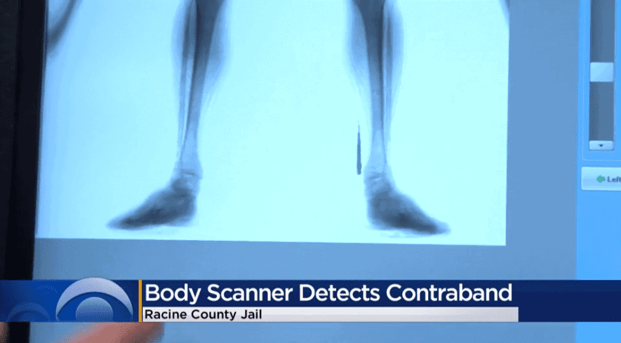X-ray image of a person's legs and feet at Racine County Jail.